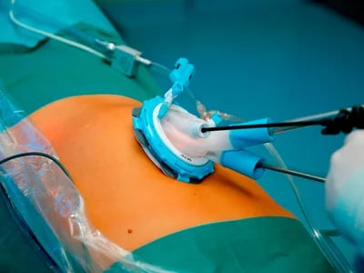 Warum immer mehr Patienten eine Magenverkleinerung Türkei wählen