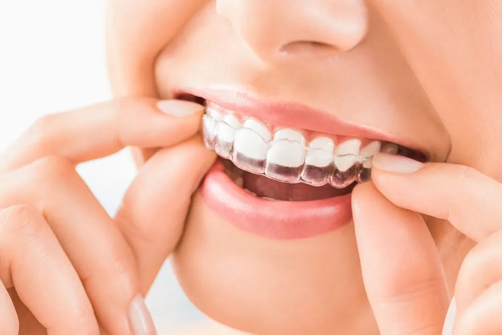 Der Zahnarzt Ihres Vertrauens: Wie Invisalign die Zahnstellungskorrektur verändert